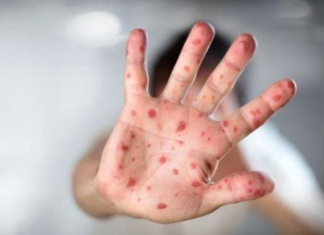 Las comunidades autónomas debatirán medidas para frenar la expansión de la mpox