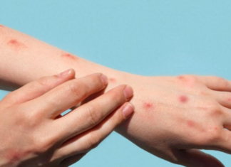 Mpox: La UE descarta controles en las fronteras y no recomienda vacunar a la población general